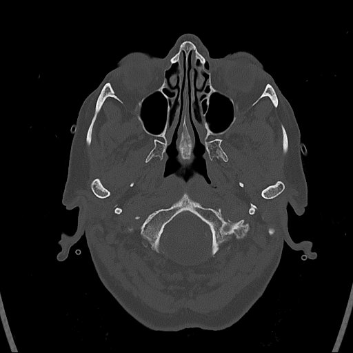 Cerebral venous infarction with hemorrhage (Radiopaedia 65343-74381 Axial bone window 1).jpg