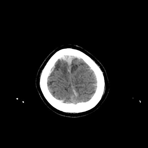 Cerebral venous throbmosis - hemorrhagic venous infarction (Radiopaedia 87318-103613 Axial non-contrast 159).jpg