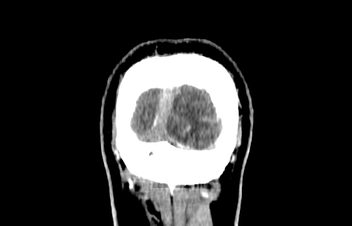Cerebral venous thrombosis (CVT) (Radiopaedia 77524-89685 C 64).jpg