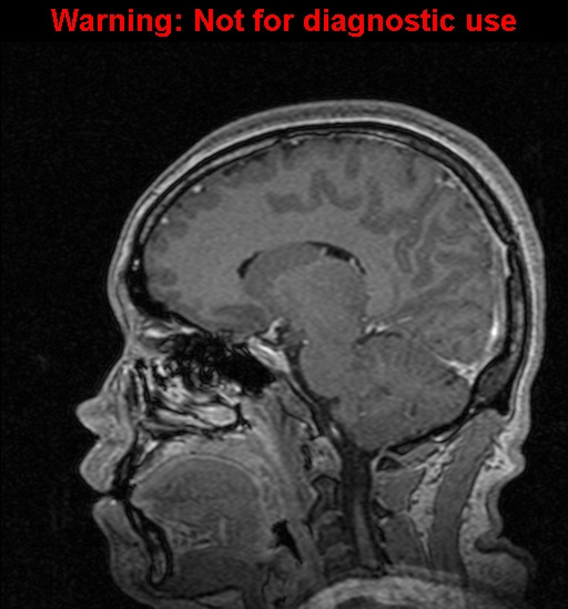 Cerebral venous thrombosis (Radiopaedia 37224-39208 Sagittal T1 C+ 87).jpg