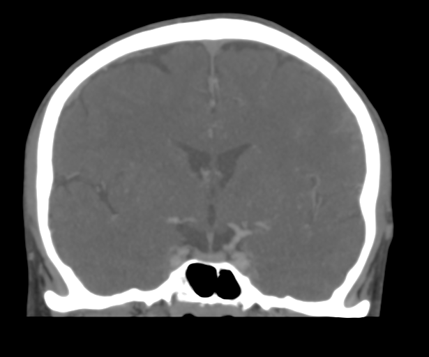 File:Cerebral venous thrombosis (Radiopaedia 38392-40467 Coronal CTA-Venogram 29).png