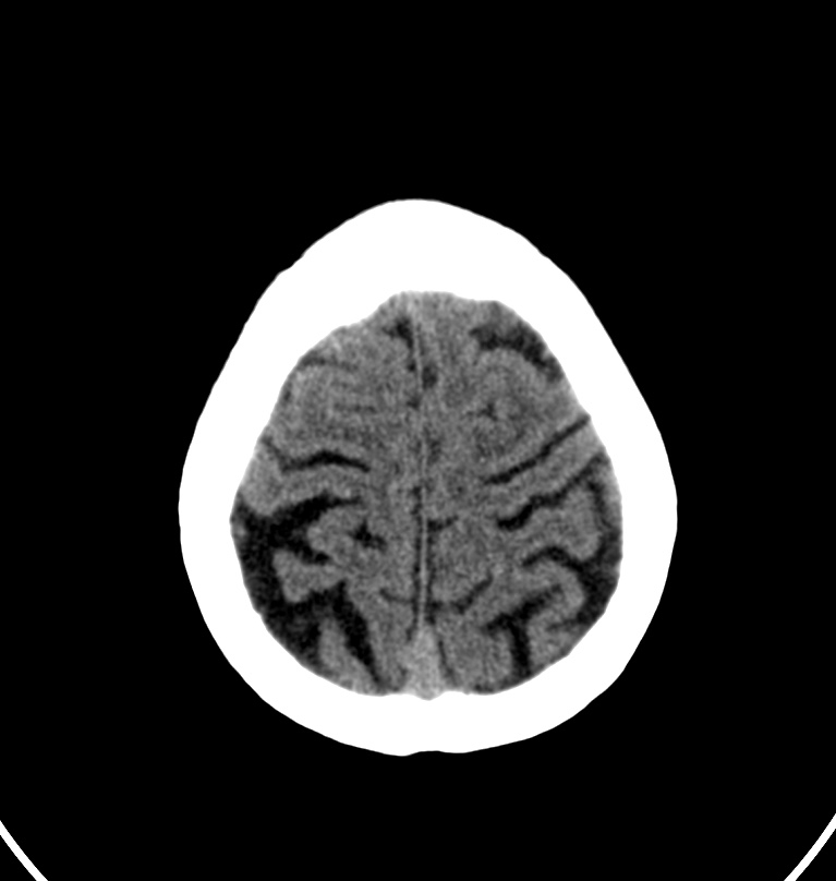 Cerebral venous thrombosis - CT only (Radiopaedia 41031-43778 Axial non-contrast 8).jpg