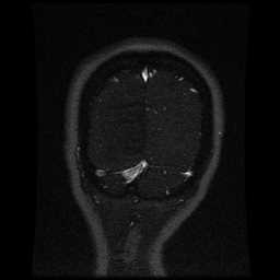 Cerebral venous thrombosis - ulcerative colitis (Radiopaedia 66049-75219 Coronal MRV 17).jpg