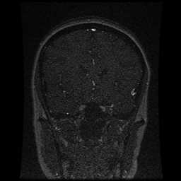 Cerebral venous thrombosis - ulcerative colitis (Radiopaedia 66049-75219 Coronal MRV 78).jpg