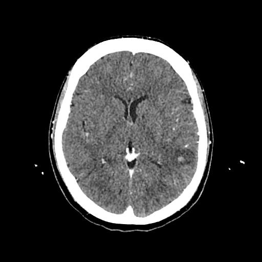Cerebral venous thrombosis with venous hemorrhagic infarct (Radiopaedia 90354-107660 Axial with contrast 88).jpg