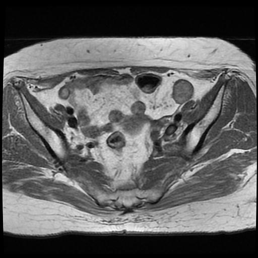 File:Cervical carcinoma (Radiopaedia 70924-81132 Axial T1 3).jpg