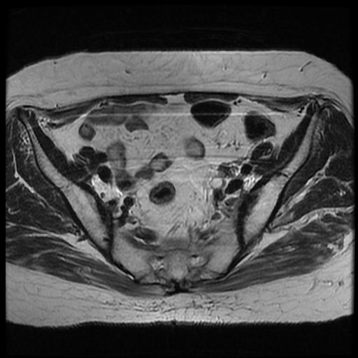 File:Cervical carcinoma (Radiopaedia 70924-81132 Axial T2 2).jpg