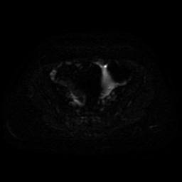 Cervical carcinoma (Radiopaedia 85405-101028 Axial DWI 16).jpg