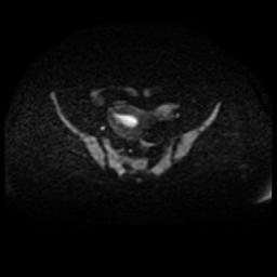Cervical carcinoma (Radiopaedia 88010-104555 Axial DWI 56).jpg