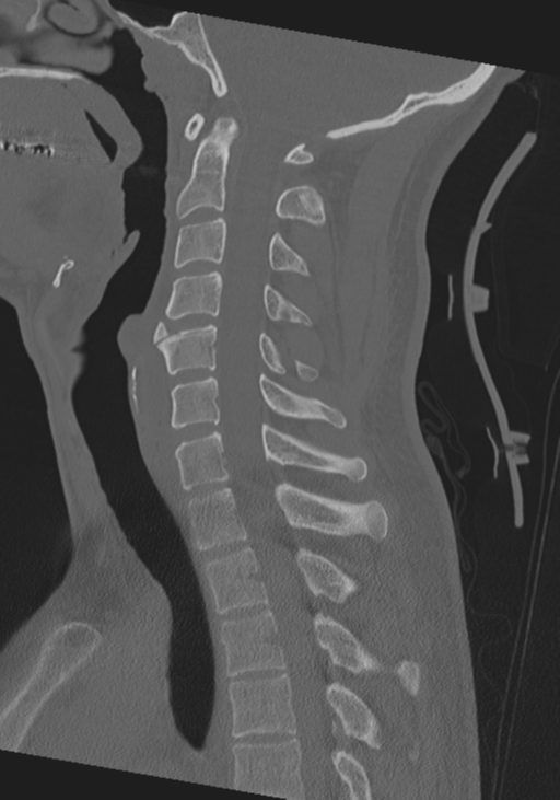 Cervical intercalary bone (Radiopaedia 35211-36748 Sagittal bone window 40).png