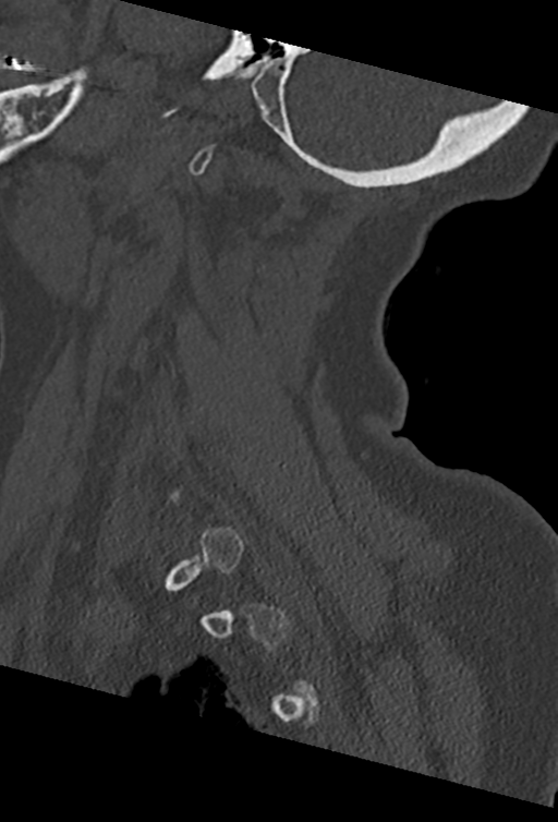 Cervical spine ACDF loosening (Radiopaedia 48998-54070 Sagittal bone window 67).png