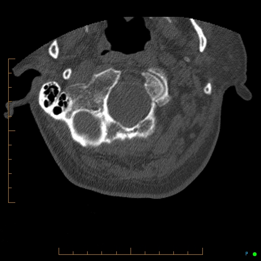 File:Cervical spine fracture - ankylosing spondylitis (Radiopaedia 76835-88706 Axial bone window 11).jpg