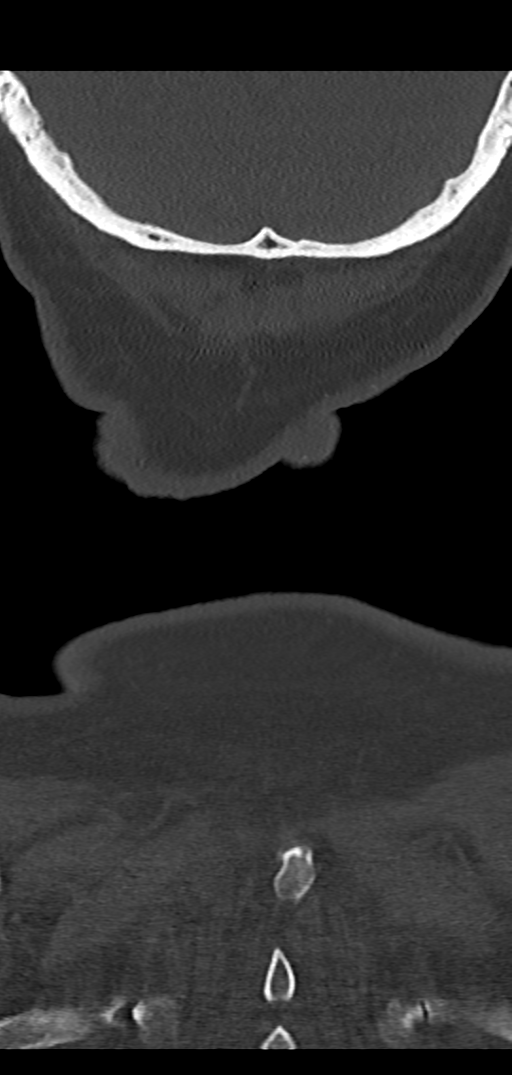 Cervical spine fracture - chalk stick (Radiopaedia 39116-41323 Coronal bone window 56).png