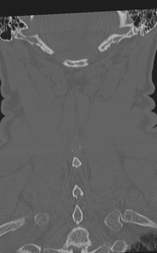 Cervical spine fractures with vertebral artery dissection (Radiopaedia 53296-59268 Coronal bone window 57).png