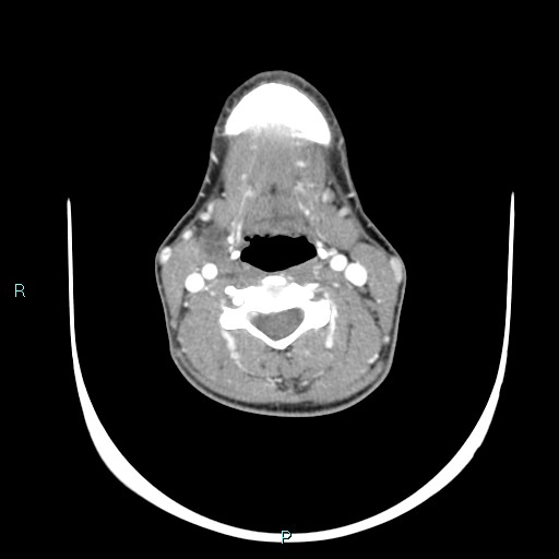 Cervical thymic cyst (Radiopaedia 88632-105335 B 64).jpg