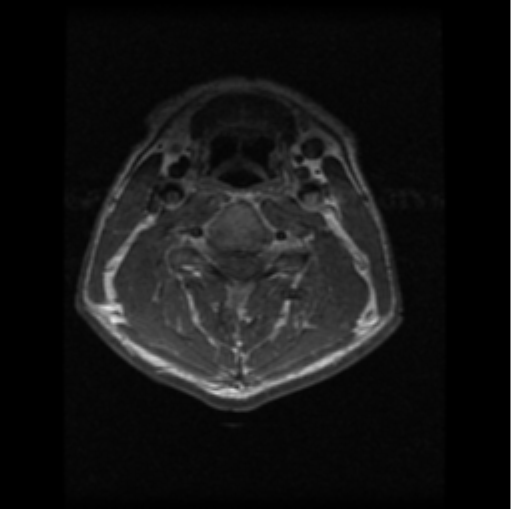File:Cervical vertebrae metastasis (Radiopaedia 78814-91667 Axial T1 C+ 12).png