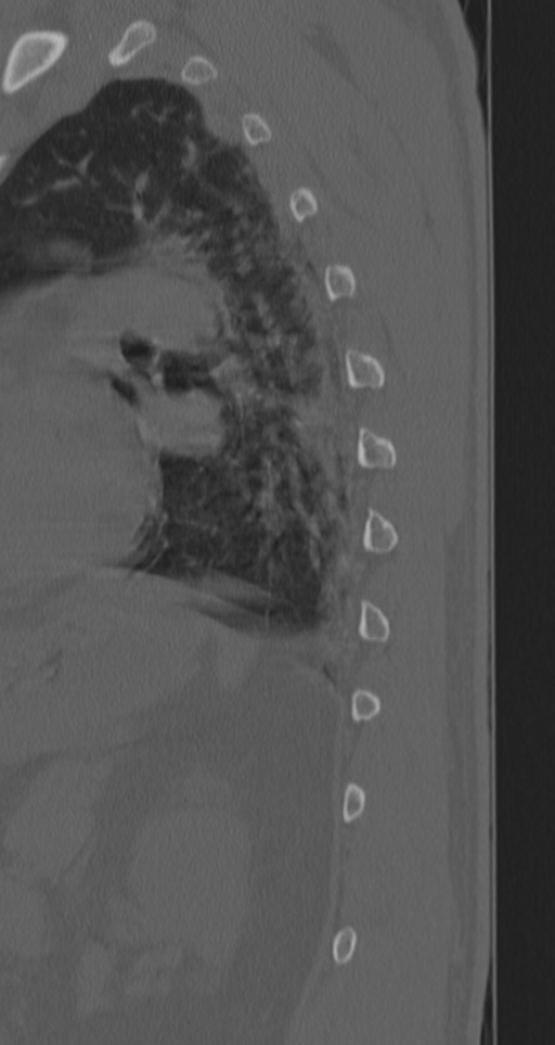 Chance fracture (Radiopaedia 33854-35020 Sagittal bone window 16).png