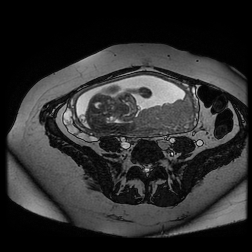 Chiari II malformation - fetal MRI (Radiopaedia 68099-77581 Axial Fiesta 30).jpg