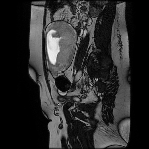 Chiari II malformation - fetal MRI (Radiopaedia 68099-77581 Sagittal Fiesta 42).jpg