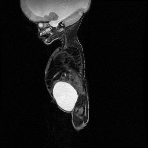 File:Chiari II malformation with spinal meningomyelocele (Radiopaedia 23550-23652 Sagittal T2 2).jpg