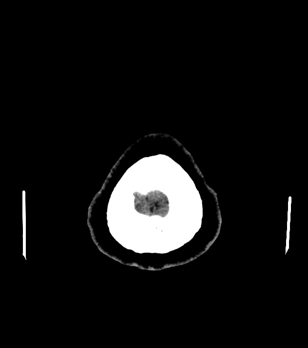 Cholangiocarcinoma with cerebral metastases (Radiopaedia 83519-98628 Axial non-contrast 62).jpg