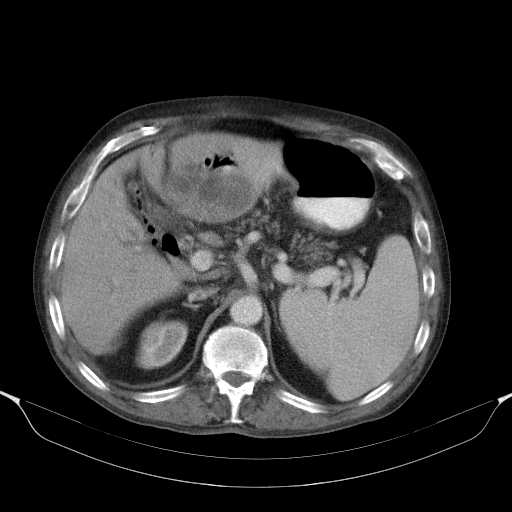 File:Cholangitis and abscess formation in a patient with cholangiocarcinoma (Radiopaedia 21194-21100 A 16).jpg