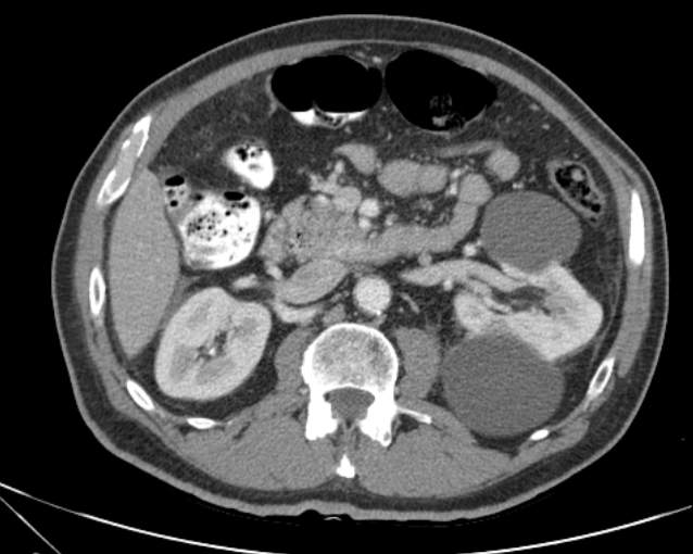 File:Cholecystitis - perforated gallbladder (Radiopaedia 57038-63916 A 37).jpg