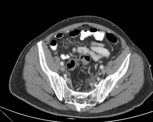 Cholecystitis - perforated gallbladder (Radiopaedia 57038-63916 A 67).jpg