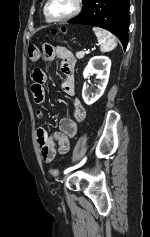 Cholecystoduodenal fistula due to calculous cholecystitis with gallstone migration (Radiopaedia 86875-103077 C 18).jpg