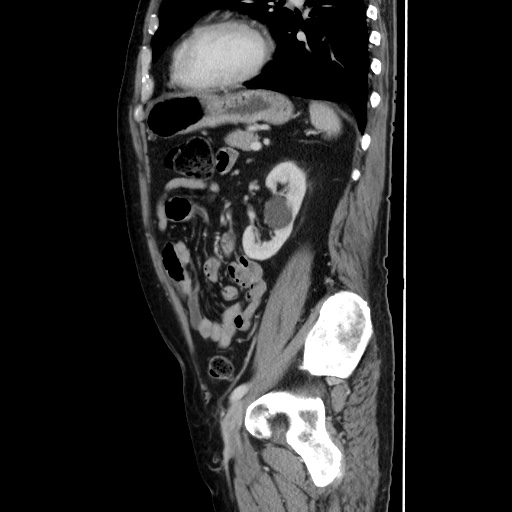 Choledocholiathiasis with normal caliber common bile duct (Radiopaedia 75368-86632 D 109).jpg