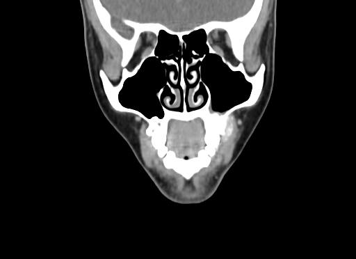 Chondroblastic osteosarcoma (Radiopaedia 67363-76741 D 29).jpg