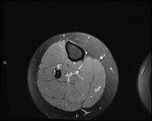 File:Chondroblastoma (Radiopaedia 62721-71031 Axial PD fat sat 40).jpg