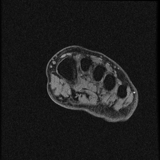 File:Chondroblastoma - midfoot (Radiopaedia 64831-73765 F 21).jpg