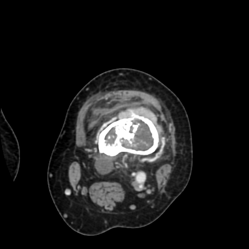 Chondrosarcoma - femur (Radiopaedia 64187-72954 Axial with contrast 32).jpg