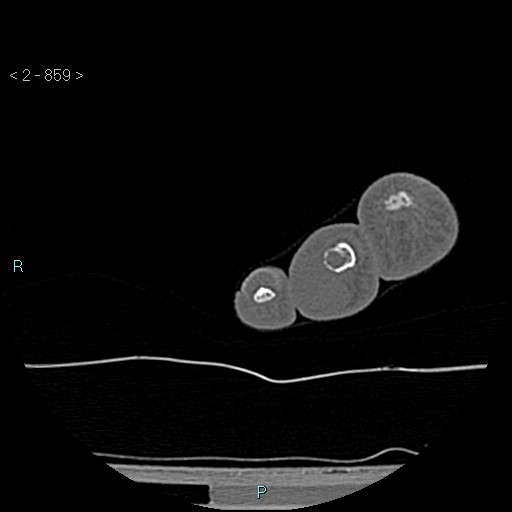 Chondrosarcoma - phalanx (Radiopaedia 69047-78812 Axial bone window 113).jpg