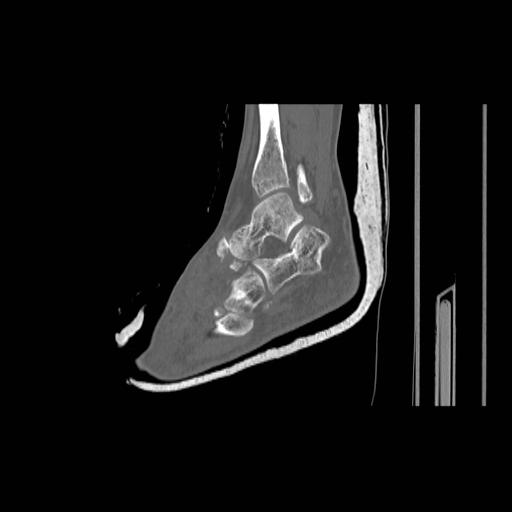 File:Chopart fracture (Radiopaedia 12386-12650 Sagittal bone window 5).jpg