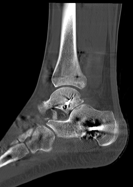 Chopart fracture (Radiopaedia 35347-36861 Sagittal bone window 47).jpg