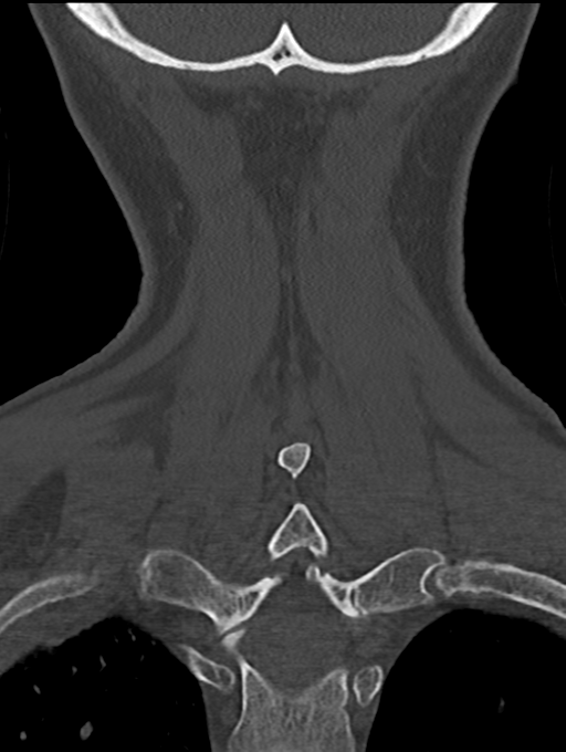 Chordoma (C4 vertebra) (Radiopaedia 47561-52188 Coronal bone window 51).png