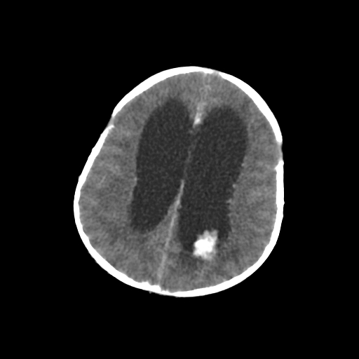 Choroid plexus papilloma (Radiopaedia 63946-72698 Axial with contrast 52).jpg