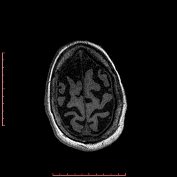 Choroid plexus xanthogranuloma (Radiopaedia 67843-77270 Axial T1 32).jpg