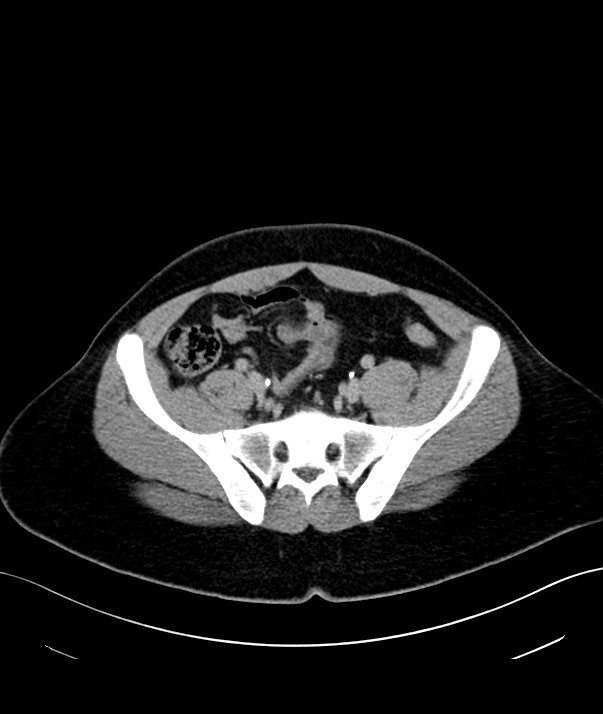 Chromophobe renal cell carcinoma (Radiopaedia 84255-99542 H 45).jpg