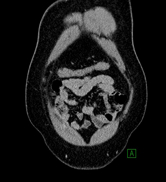 Chromophobe renal cell carcinoma (Radiopaedia 84286-99573 H 23).jpg