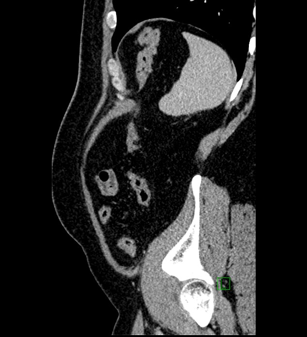 Chromophobe renal cell carcinoma (Radiopaedia 84286-99573 I 26).jpg