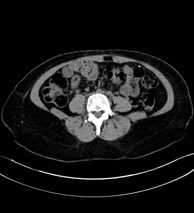 Chromophobe renal cell carcinoma (Radiopaedia 84290-99582 Axial non-contrast 90).jpg