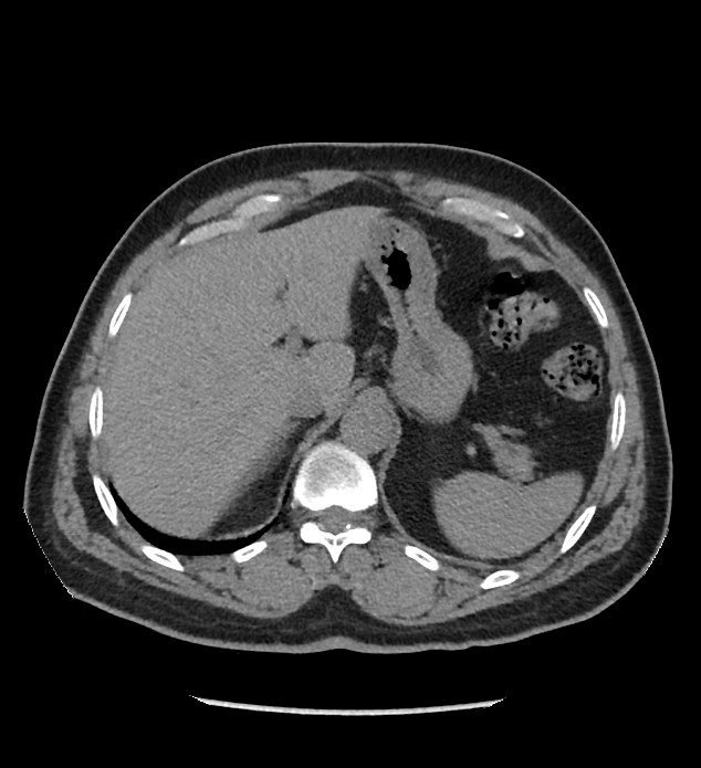 Chromophobe renal cell carcinoma (Radiopaedia 86879-103083 Axial non-contrast 12).jpg
