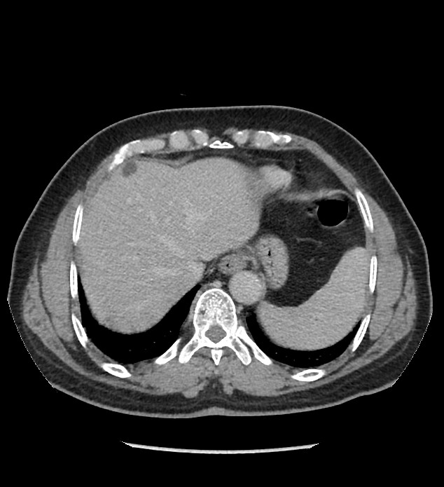 Chromophobe renal cell carcinoma (Radiopaedia 86879-103083 C 16).jpg