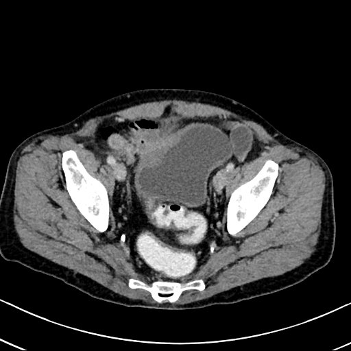 Chronic appendicitis complicated by appendicular abscess, pylephlebitis and liver abscess (Radiopaedia 54483-60700 B 126).jpg
