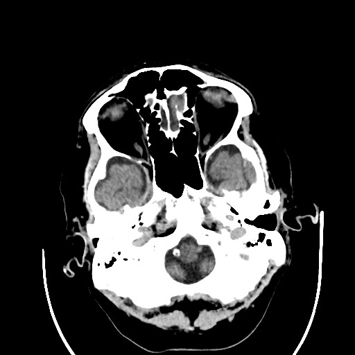 Chronic bilateral subdural hygroma (Radiopaedia 85801-101622 Axial non-contrast 28).jpg