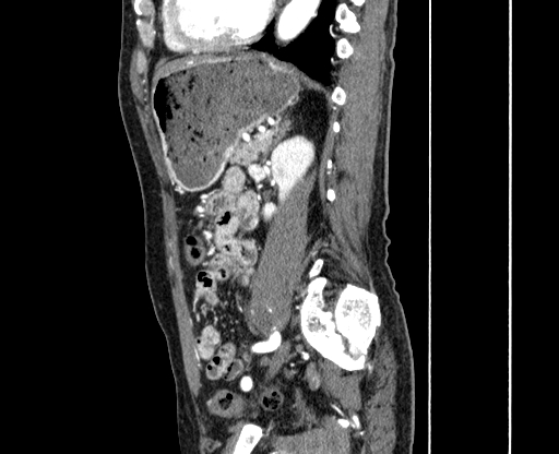 File:Chronic contained rupture of abdominal aortic aneurysm with extensive erosion of the vertebral bodies (Radiopaedia 55450-61901 B 52).jpg