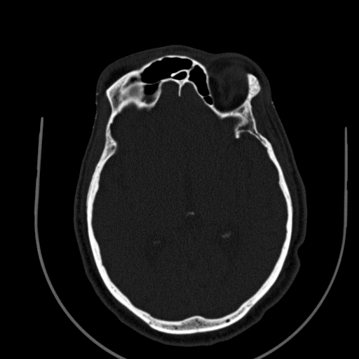 Chronic invasive fungal sinusitis (Radiopaedia 91563-109286 Axial sinus 123).jpg